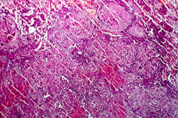 Miliaria tüberkülozu, ışık test — Stok fotoğraf