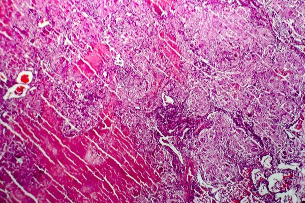 Tuberculosis miliar, micrografía ligera — Foto de Stock