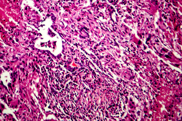 Miliary tuberculosis, light micrograph