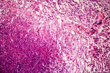 Tubercle, ışık test