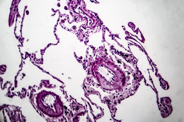 Enfisema pulmonar, micrografía ligera — Foto de Stock