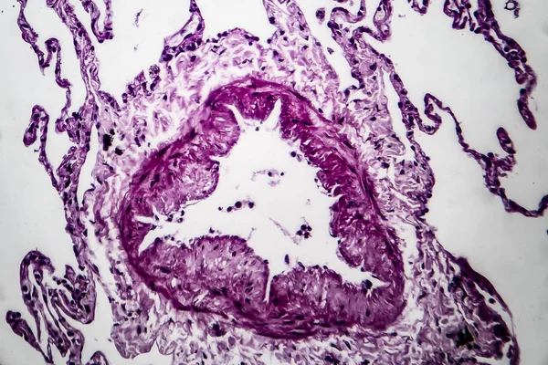 Emphysème pulmonaire, micrographie photonique — Photo