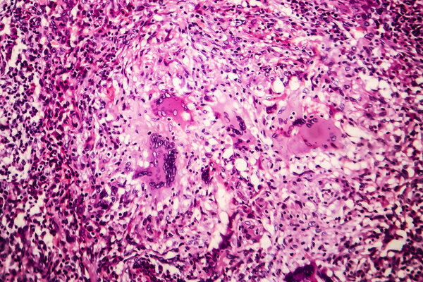 Tubercle, light micrograph