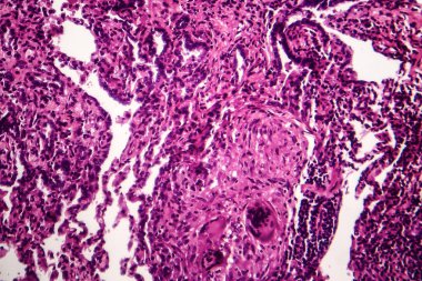 Caseous pnömoni, ışık test