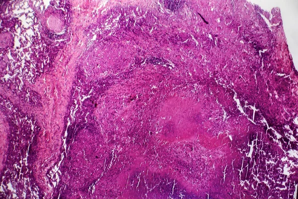 Caseous pneumonia, light micrograph — Stock Photo, Image