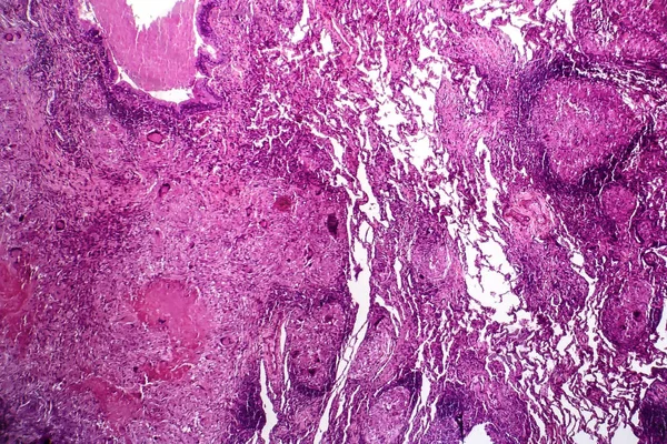 Caseous pnömoni, ışık test — Stok fotoğraf