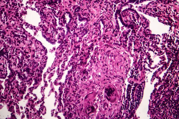 乾酪性肺炎、光学顕微鏡像 — ストック写真