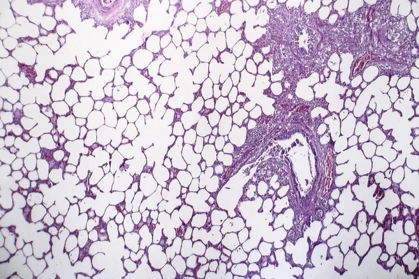 Neumonía, micrografía ligera — Foto de Stock