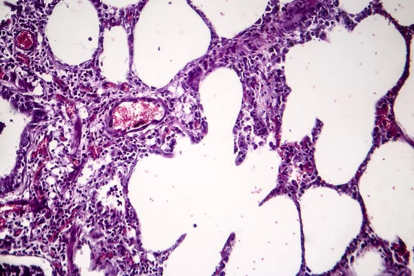 Tüdőgyulladás, könnyű elektronmikroszkópos — Stock Fotó