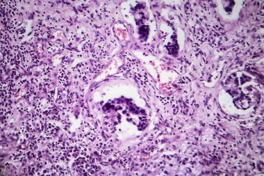 Gastrik adenokarsinom, ışık test