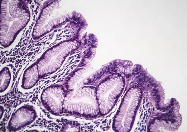 Χρόνιας γαστρίτιδας επιφανειακή, φως μικρογραφία — Φωτογραφία Αρχείου