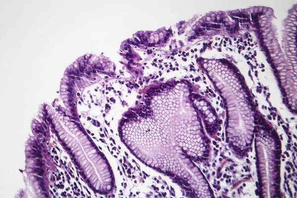 慢性浅表性胃炎, 光显微镜 — 图库照片