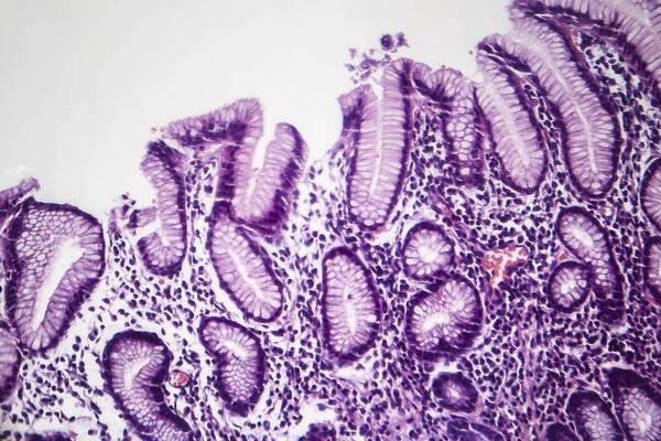 慢性胃炎、光学顕微鏡像 — ストック写真