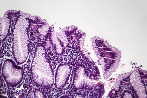 Przewlekłe zapalenie żołądka powierzchowne, lekkie mikrogram — Zdjęcie stockowe