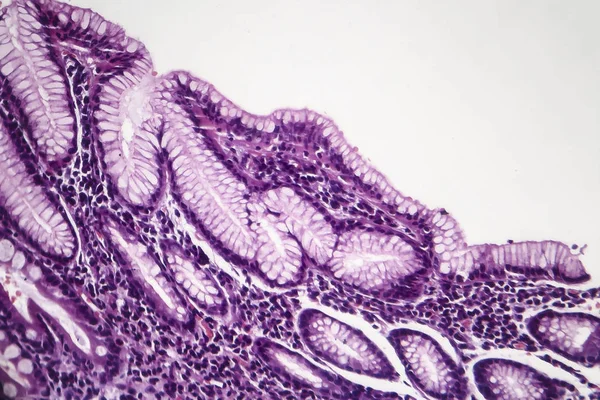 慢性浅表性胃炎, 光显微镜 — 图库照片