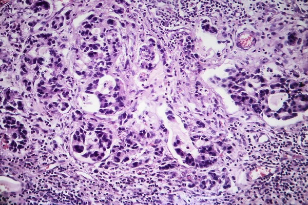 Adenocarcinoma gastrico, micrografo leggero — Foto Stock