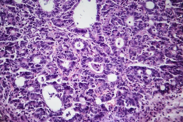 Adenocarcinoma gastrico, micrografo leggero — Foto Stock