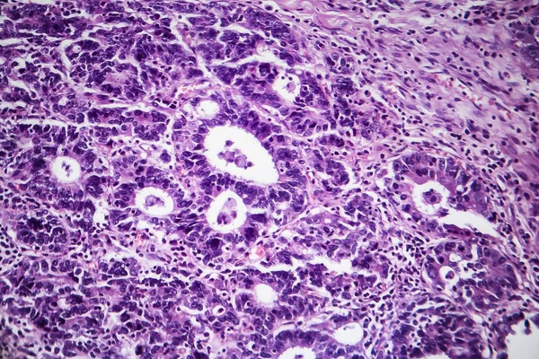 Adenocarcinoma gastrico, micrografo leggero — Foto Stock