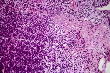 Akut apandisit basit, hafif test