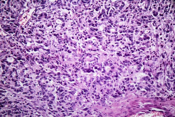 Adenocarcinoma gástrico, micrografia de luz — Fotografia de Stock