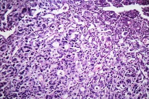 Adenocarcinoma gastrico, micrografo leggero — Foto Stock