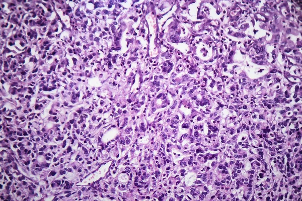 胃腺癌、光学顕微鏡像 — ストック写真