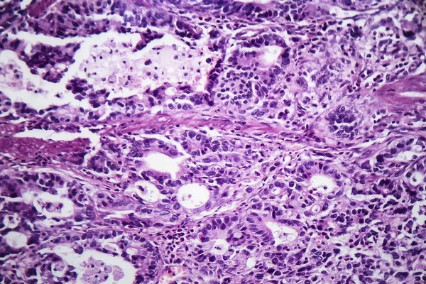 Gastric adenocarcinoma, light micrograph — Stock Photo, Image