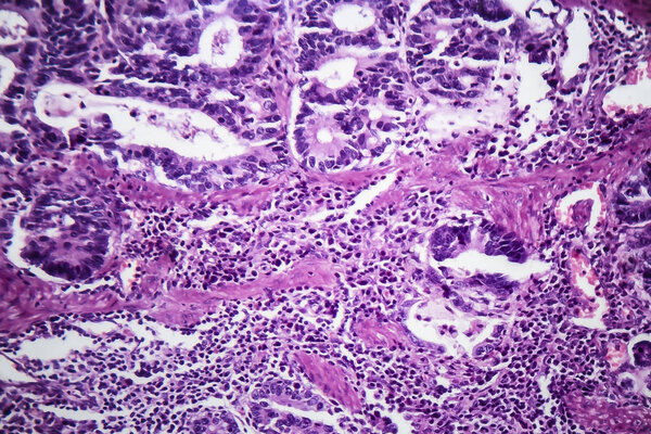 Gastric adenocarcinoma, light micrograph