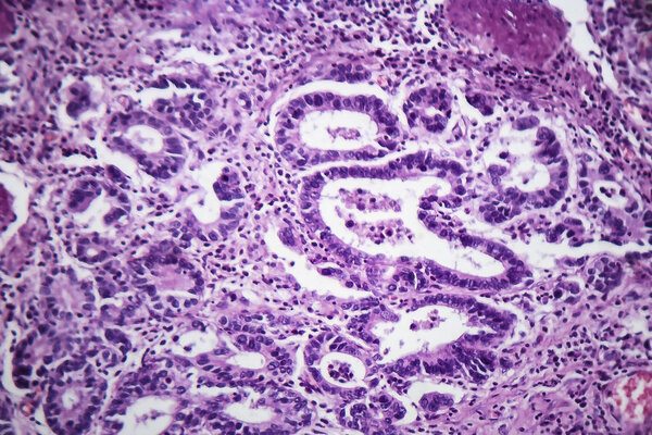 Аденокарцинома желудка, световой микрограф
