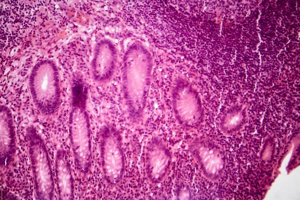 単純な急性虫垂炎、顕微鏡像 — ストック写真