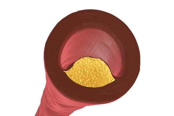 Atherosclerotic plaque in human artery