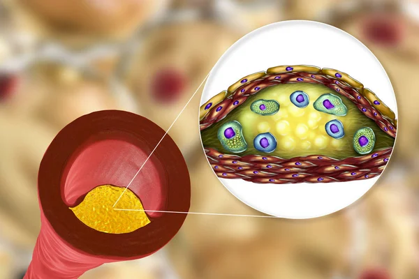 Tablica miażdżycowe w ludzkiej tętnicy — Zdjęcie stockowe