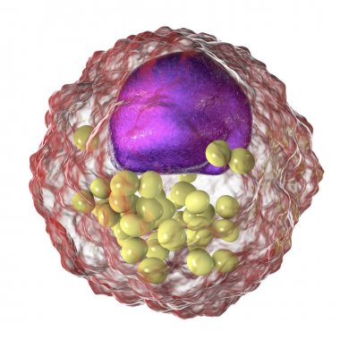 Köpük hücresi, lipid damlacıkları içeren makrophaj hücreleri