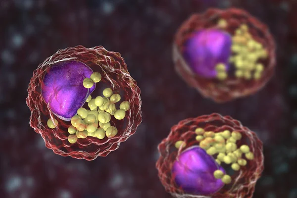 Células espumosas, macrófagos que contêm gotículas lipídicas — Fotografia de Stock
