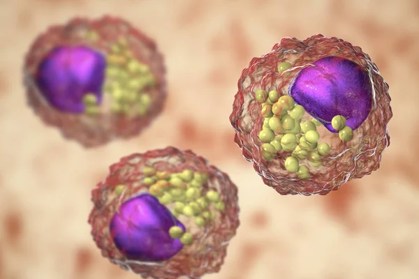 Пінисті клітини, клітини макрофагів, які містять ліпідні краплі — стокове фото