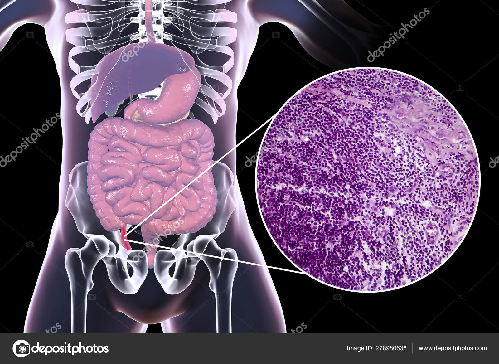 Apendicitis aguda, ilustración y micrografía ligera — Foto de stock  #278980638 © katerynakon, image size:1600x1167