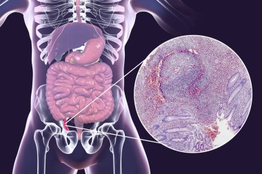 Chronic appendicitis, illustration and light micrograph clipart