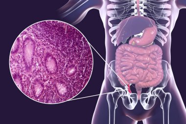 Acute appendicitis, illustration and light micrograph clipart