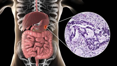 Stomach adenocarcinoma, gastric cancer, illustration and light micrograph clipart