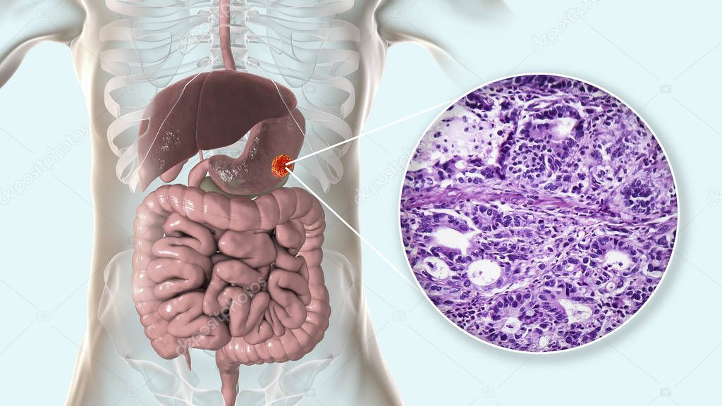 Stomach adenocarcinoma, gastric cancer, illustration and light micrograph