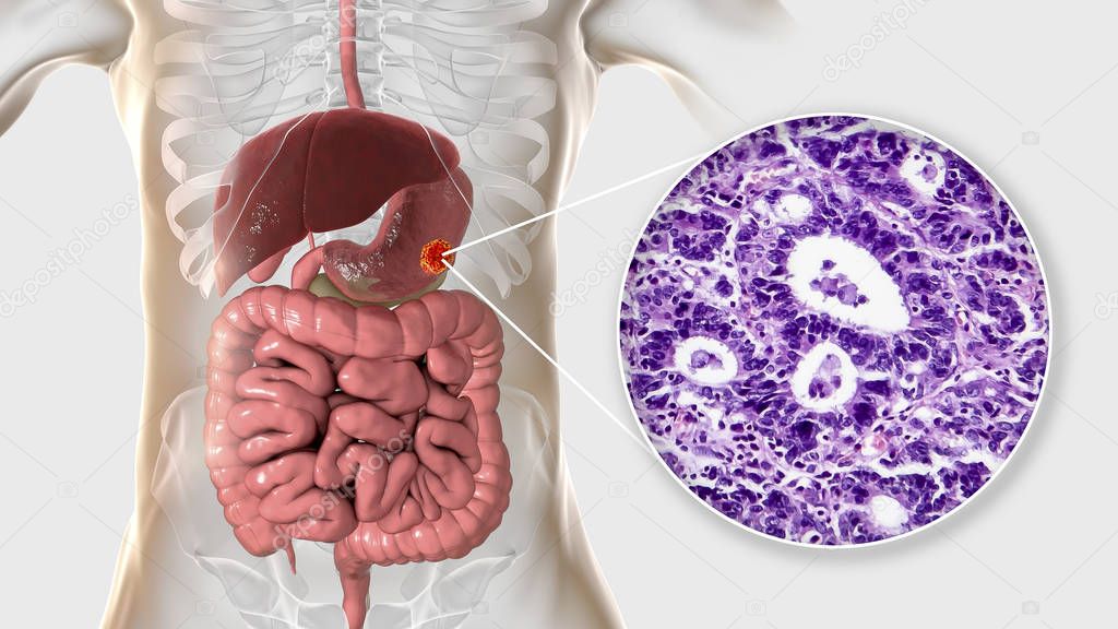 Stomach adenocarcinoma, gastric cancer, illustration and light micrograph