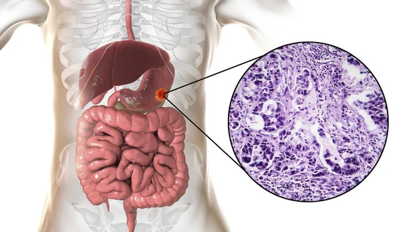 胃腺癌,胃癌,插图和光显微图 — 图库照片