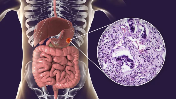 胃腺癌,胃癌,插图和光显微图 — 图库照片