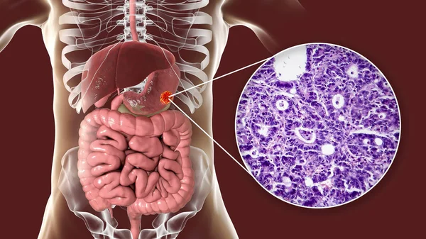 Stomach adenocarcinoma, gastric cancer, illustration and light micrograph