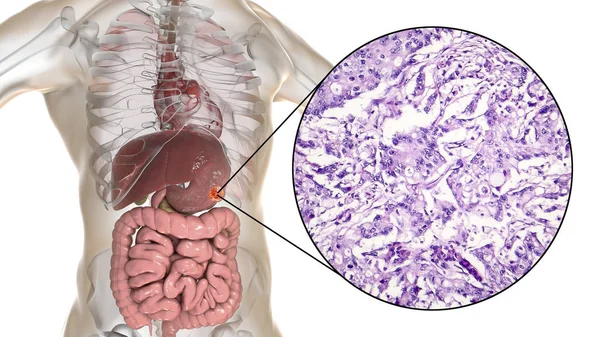 Adenocarcinoma mucinoso de estómago, ilustración y micrografía — Foto de Stock