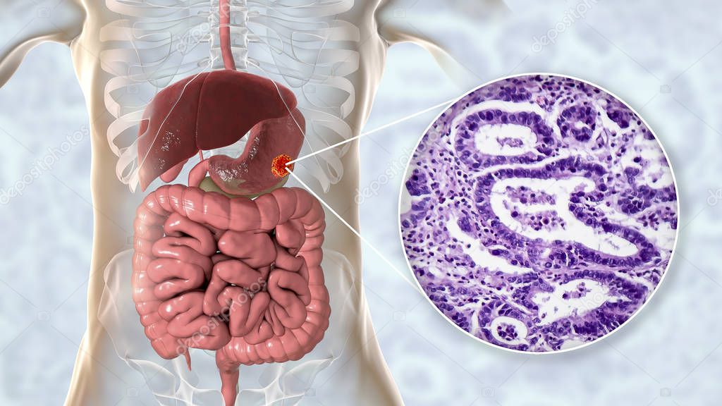 Stomach adenocarcinoma, gastric cancer, illustration and light micrograph