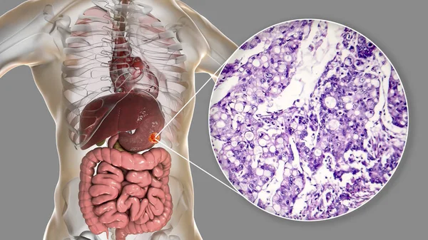 Adenocarcinoma mucinoso de estómago, ilustración y micrografía — Foto de Stock