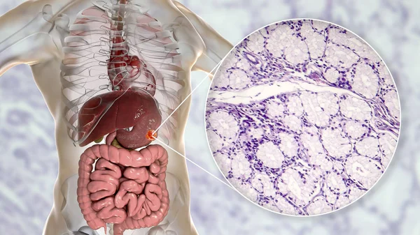 Adenocarcinoma mucinoso de estómago, ilustración y micrografía — Foto de Stock