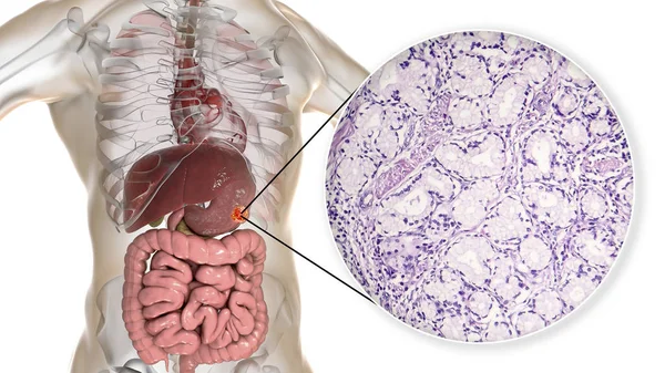 Mucinous adenocarcinoma of stomach, illustration and micrograph — Stock Photo, Image
