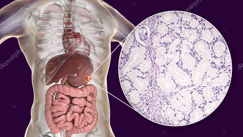 Mucinous adenocarcinoma of stomach, illustration and micrograph